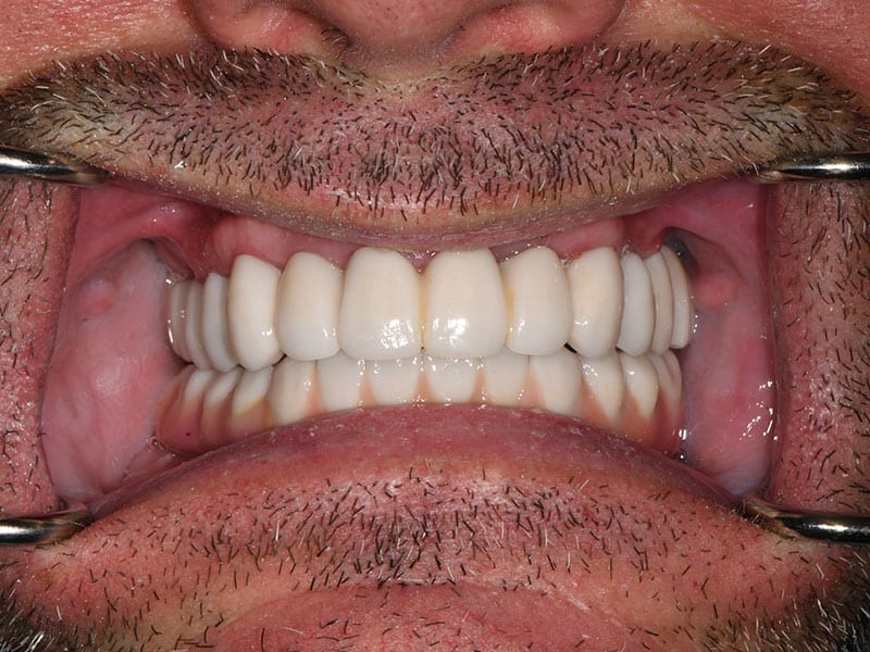 After1 | Restore Dental Arts