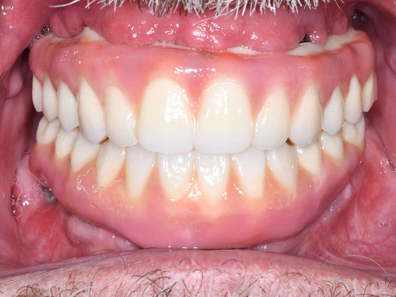 BrAfter1 | Restore Dental Arts Close-up photo of a full set of upper and lower teeth with pink gums, showing straight, well-aligned dentition in a bite.